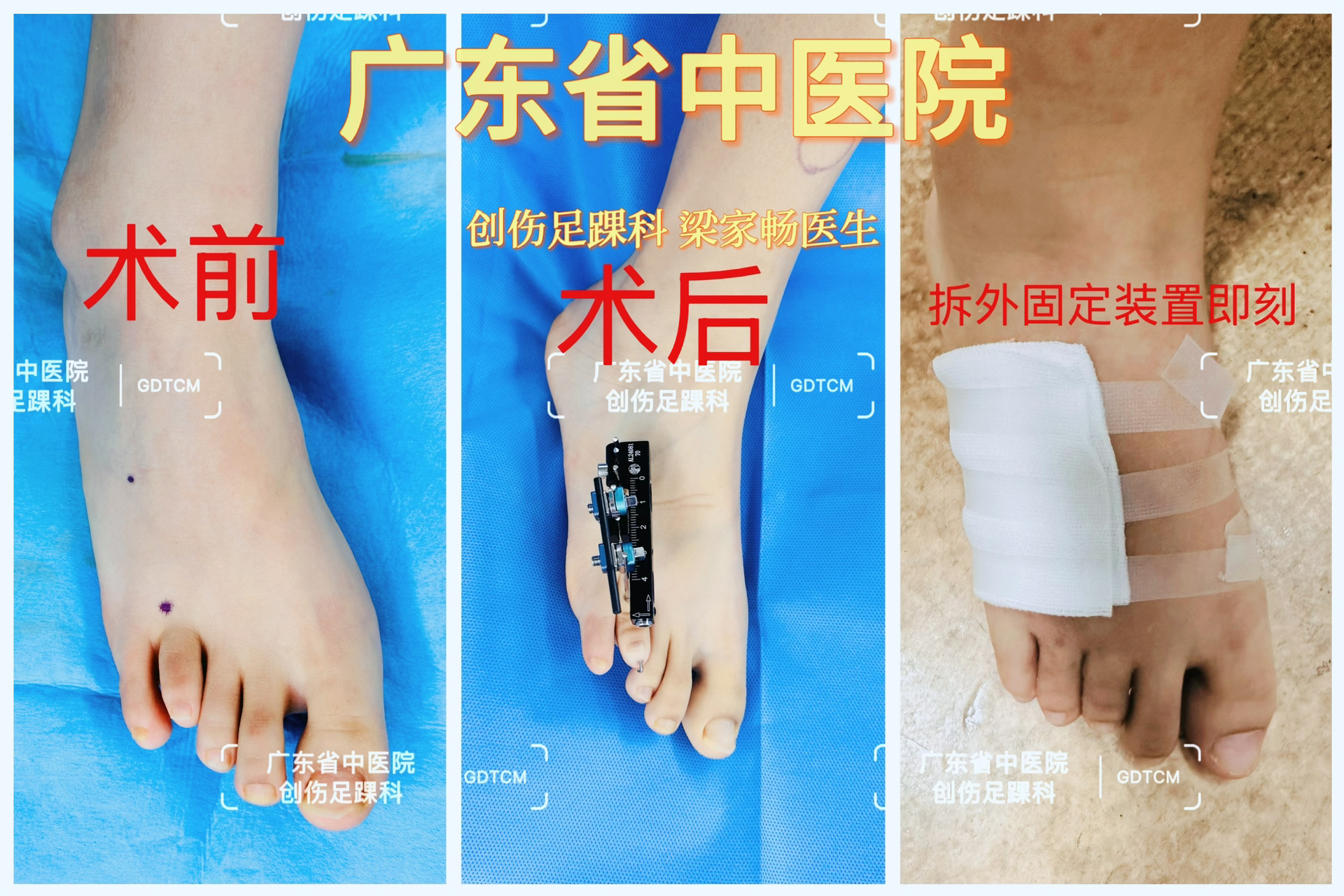 穆西亚拉腓骨骨折手术成功开始进入恢复阶段的简单介绍